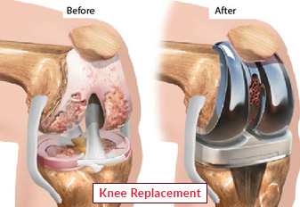 Knee Replacement Surgery