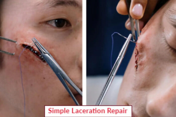 Laceration Repair