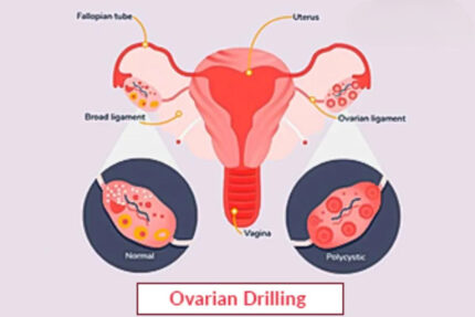 Laparoscopic Ovarian Drilling