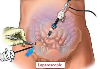 Laparoscopic Surgery