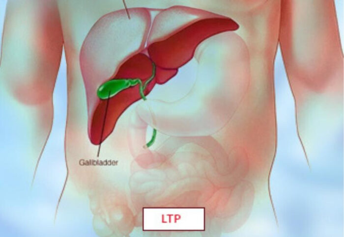 Laryngotracheoplasty