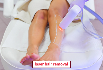 Laser Hair Removal