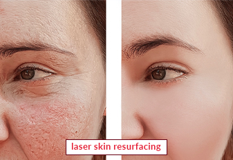 Laser Skin Resurfacing