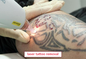 Laser Tattoo Removal