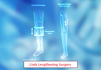 Limb Lengthening Surgery