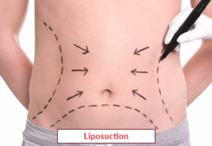 Liposuction