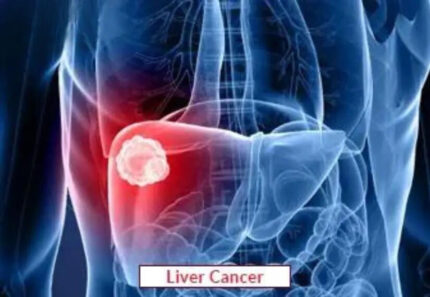 Liver Cancer