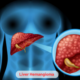 Liver Hemangioma product Image