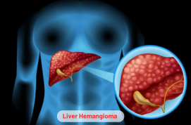Liver Hemangioma product Image