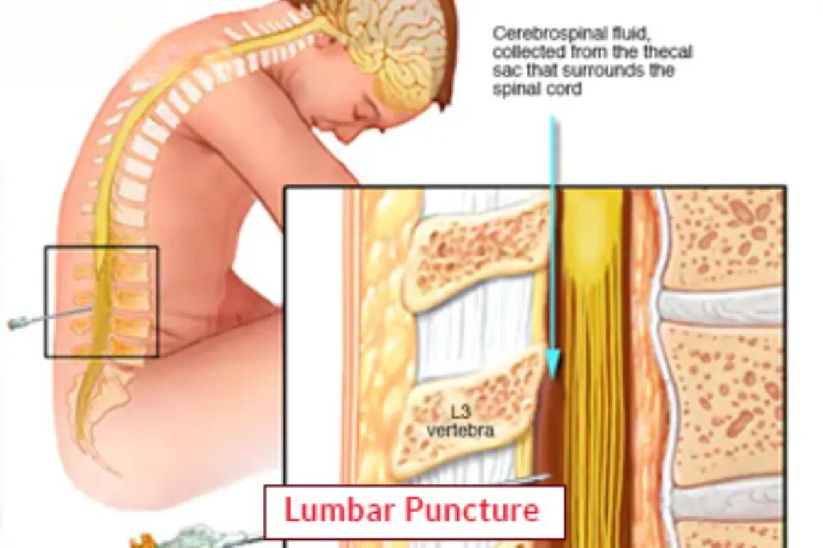 Lumbar Puncture