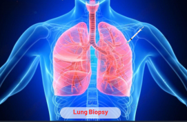 Lung Biopsy