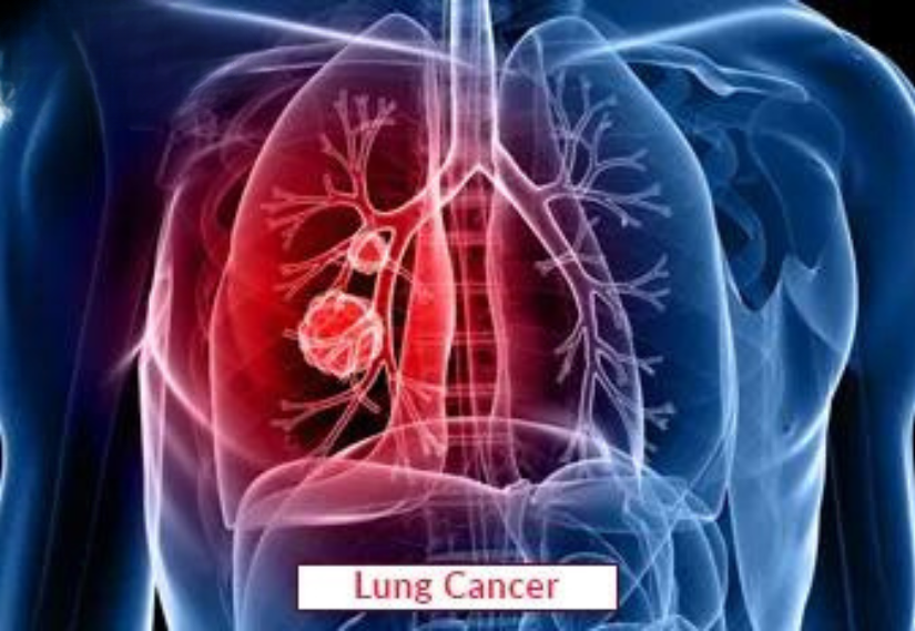 Lung Cancer