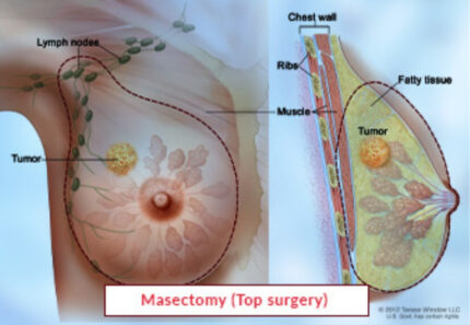 Mastectomy Surgery