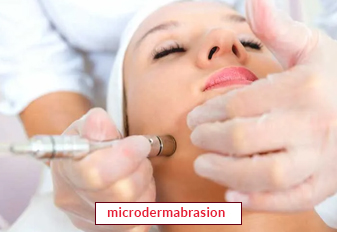 Microdermabrasion