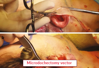 Microdochectomy