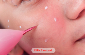 Milia Removal