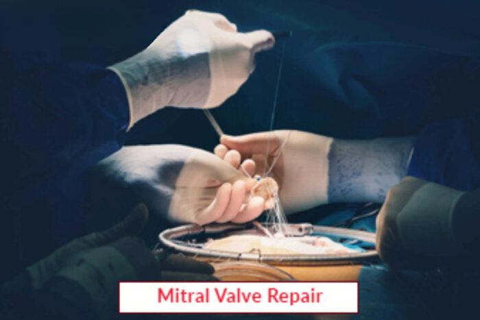 Mitral Valve Repair product Image