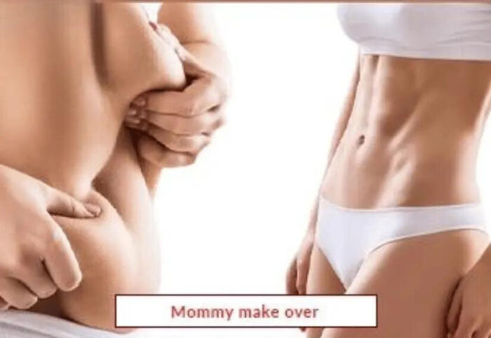 Mommy Makeover