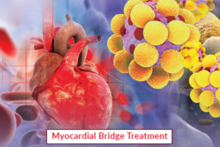 Myocardial Bridge Treatment product Image