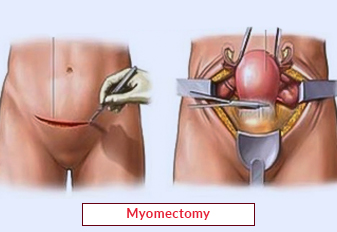 Myomectomy