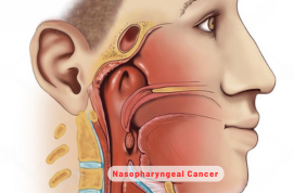 Nasopharyngeal Cancer