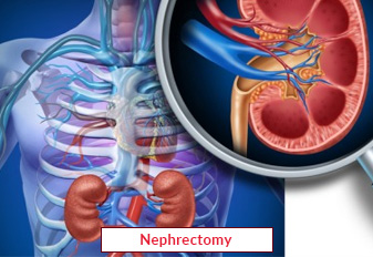 Nephrectomy Surgery