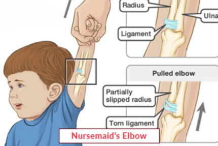 Nursemaid’s Elbow Treatment