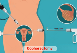 Oophorectomy