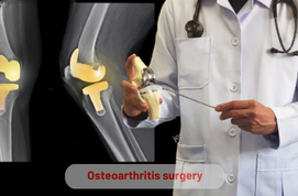 Osteoarthritis surgery