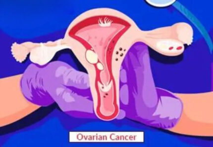 Ovarian Cancer