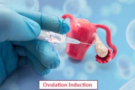 Ovulation Induction