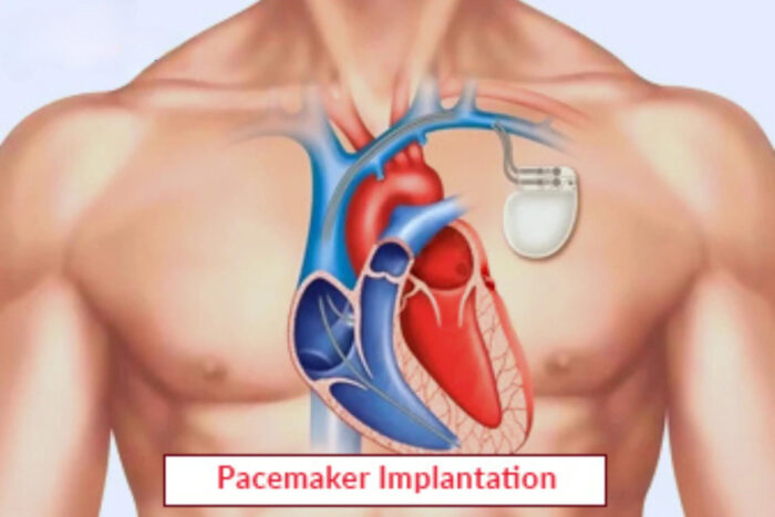 Pacemaker Implantation