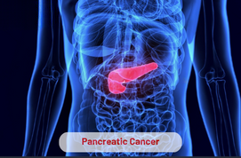 Pancreatic Cancer