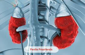 Penile Prosthesis