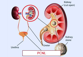 Percutaneous Nephrolithotomy (PCNL)