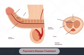 Peyronie’s Disease Treatment