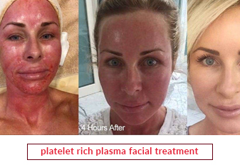 Platelet Rich Plasma Facial Treatment