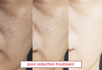 Pore Reduction Treatment