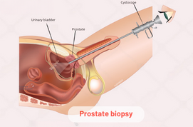 Prostate Biopsy