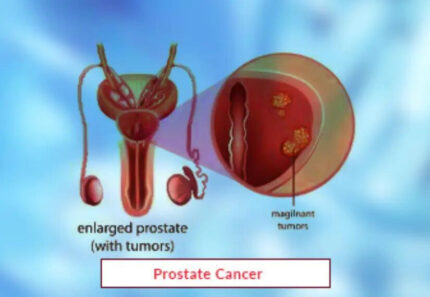 Prostate Cancer