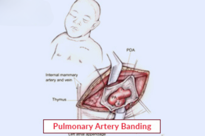 Pulmonary Artery Banding