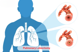 Pulmonary Lobectomy