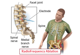 Radiofrequency Ablation