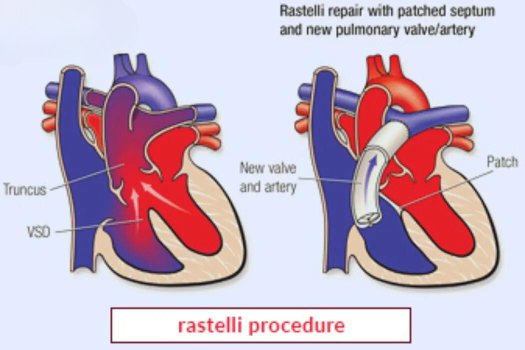 Rastelli Procedur