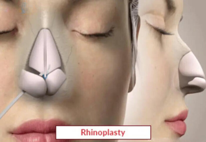 Rhinoplasty Surgery