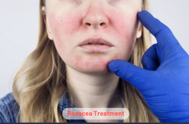 Rosacea Treatment