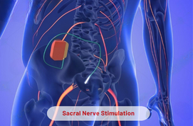 Sacral Nerve Stimulation