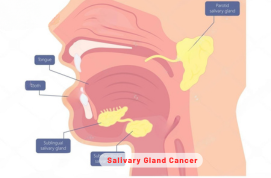 Salivary Gland Cancer