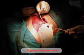 Salpingo-Oophorectomy