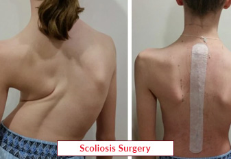 Scoliosis Spine Surgery